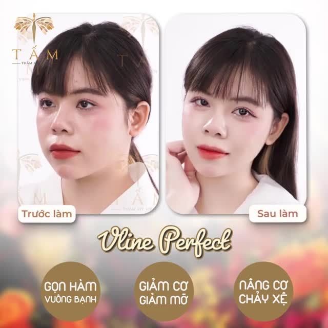 MẶT LỆCH, CƠ CO CỨNG, GÓC HÀM VUÔNG TO, NHIỀU MỠ
