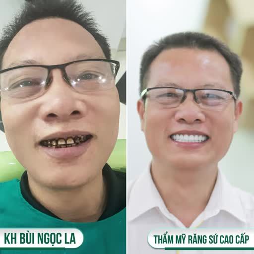 KHOẢNG CÁCH XA KHÔNG CÒN LÀ TRỞ NGẠI KHI MUỐN KHẮC PHỤC RĂNG NHIỄM MÀU KHÁNG SINH