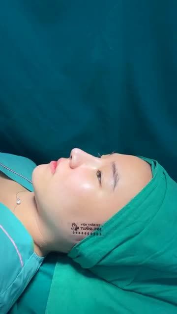 Nâng mũi cấu trúc, dáng mũi cao, đầu mũi tròn bay cho khách hàng 9X đến từ Vũng Tàu