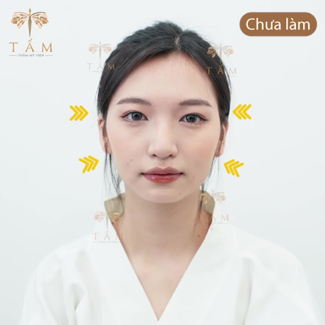 “Sau khi làm xong thì gương mặt mình đầy đặn và hài hoà hơn, trông trẻ hẳn ra.” là chia sẻ của bạn khách xinh đẹp Phương Anh sau khi sử dụng combo filler thái dương, má, cằm bên Tấm.