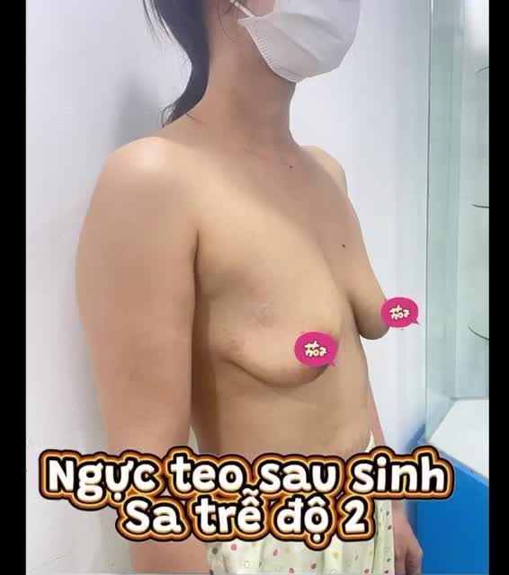 Ngực nhỏ sau sinh thường kèm thêm sa trễ. Phẫu thuật làm đẹp vòng 1 cho chị em trong trường hợp này sẽ gồm 2 việc đồng thời:
