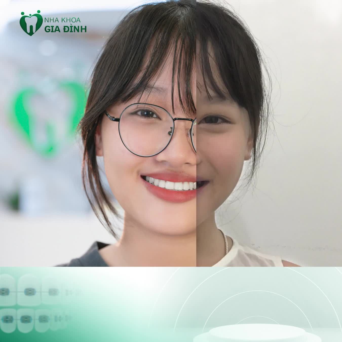 CHIÊM NGƯỠNG SỰ THAY ĐỔI CỦA CÁC KHÁCH HÀNG NIỀNG RĂNG TẠI NHA KHOA GIA ĐÌNH