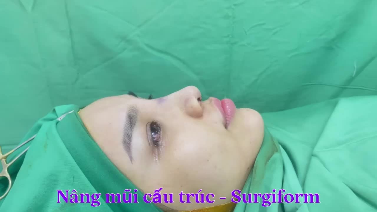 Nâng mũi cấu trúc Surgiform luôn là lựa chọn tạo dáng mũi đẹp dài lâu