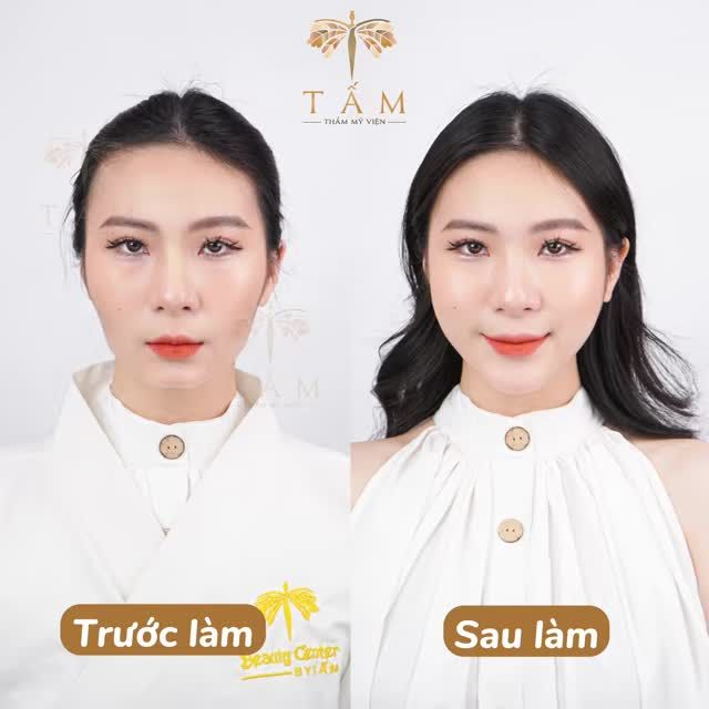 Chấm dứt khuyết điểm má hóp, cằm ngắn, gương mặt thiếu cân đối chỉ sau 30 phút với filler má, cằm tại Tấm.