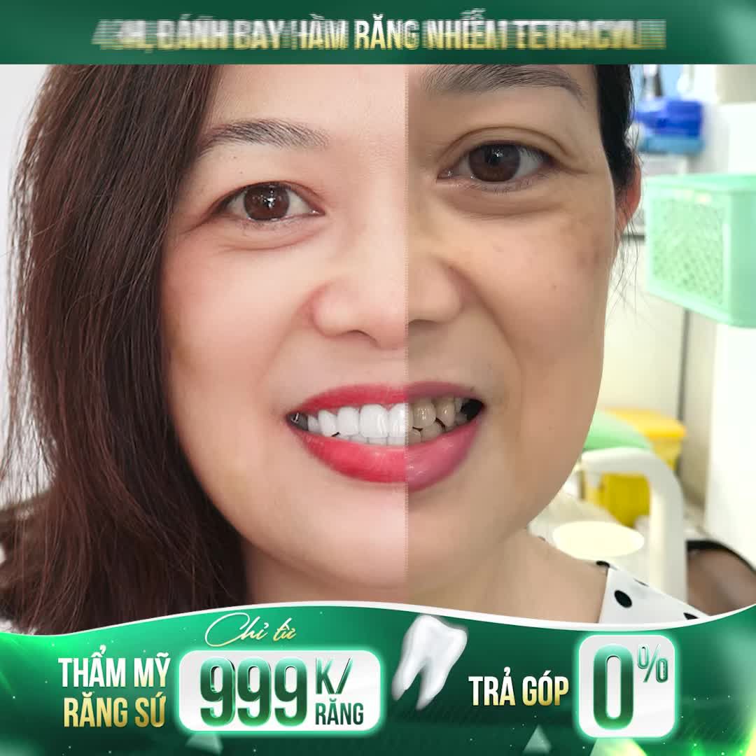 ĐÁNH BAY HÀM RĂNG NHIỄM TETRACYLIN CHỈ SAU 48H – THẨM MỸ RĂNG SỨ CHỈ TỪ 999K