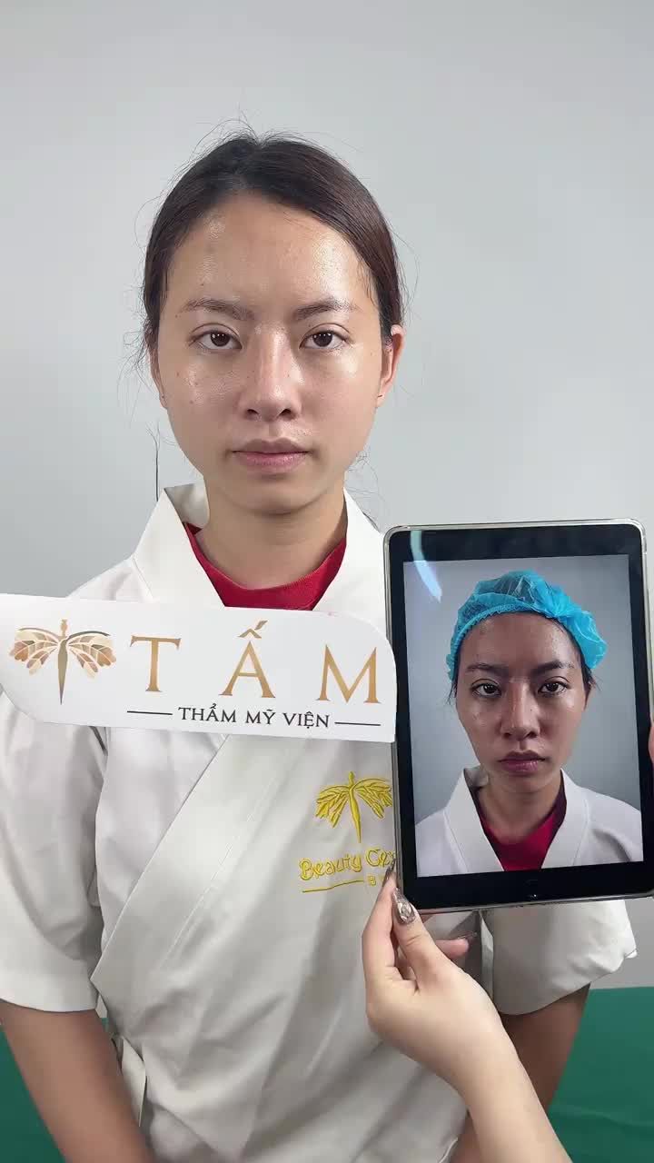 Thay đổi ngoạn mục sau khi sử dụng filler má tại Tấm.