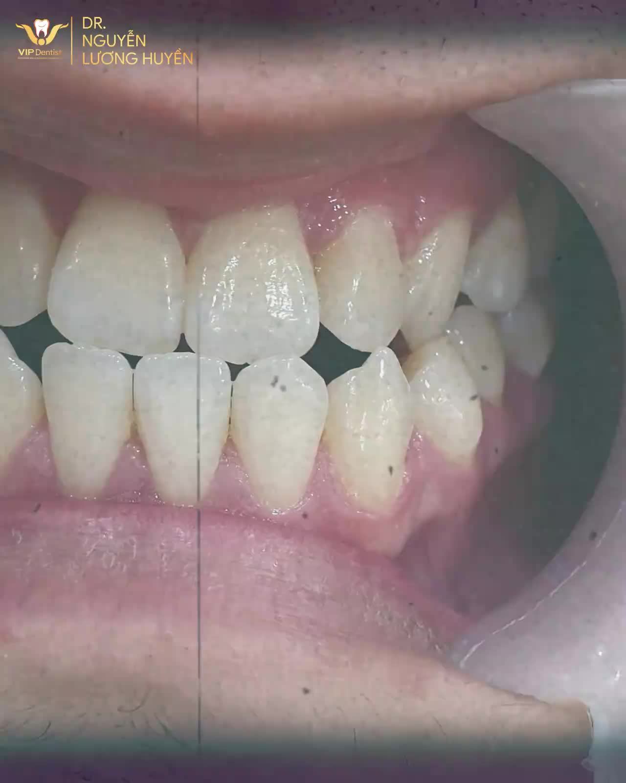 "NIỀNG KHÔNG NHỔ RĂNG MÀ VẪN ĐẠT ĐƯỢC HIỆU QUẢ CAO MỚI LÀ ĐIỀU KHÓ!"