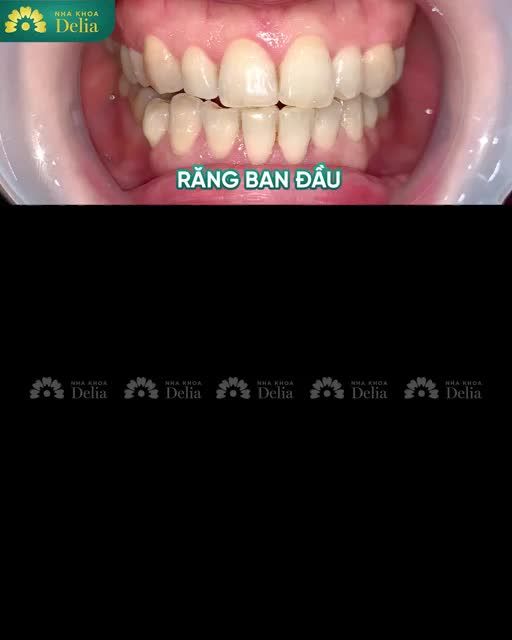 “Hết hô rồi giờ mình chỉ thấy răng trắng, sáng, đều đẹp thôi. Màu sắc răng rất tự nhiên và hình dáng được thẩm mỹ như ý muốn” - Chị Vũ Thị Giang rạng rỡ chia sẻ.