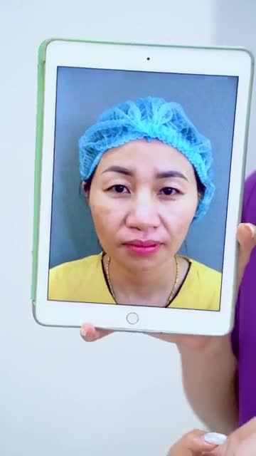 Combo trẻ hóa mí mắt toàn diện Nâng cung mày + Cắt mí trên giúp khách hàng trẻ trung như thế nào?