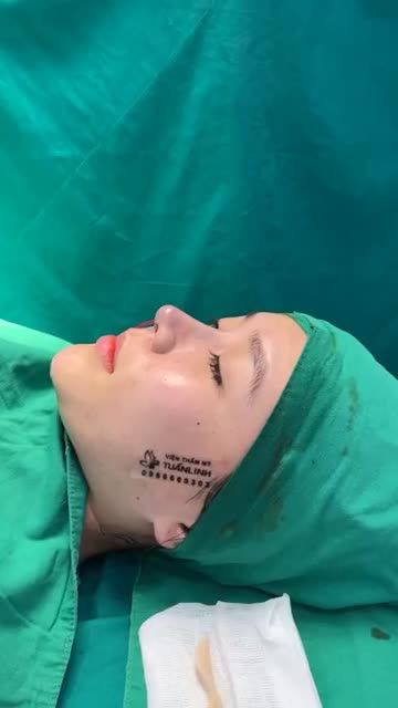 Nâng mũi cấu trúc sửa lại sử dụng Surgiform cho bạn gái đến từ Bình Dương!