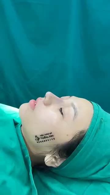 Case mũi cấu trúc bóc chỉ vừa mới hoàn thành
