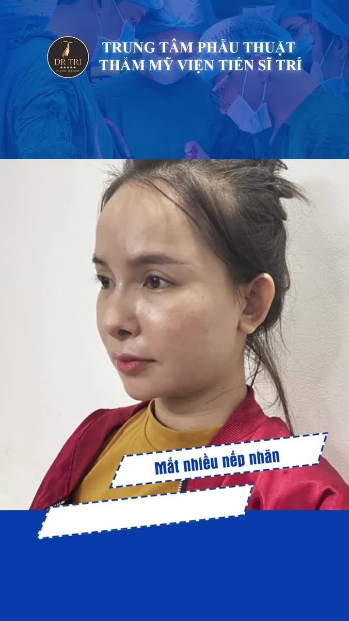 TẠI SAO CÁC CHỊ ĐẸP NHẤT QUYẾT PHẢI CĂNG DA VLINE Ở DR TRÍ ?