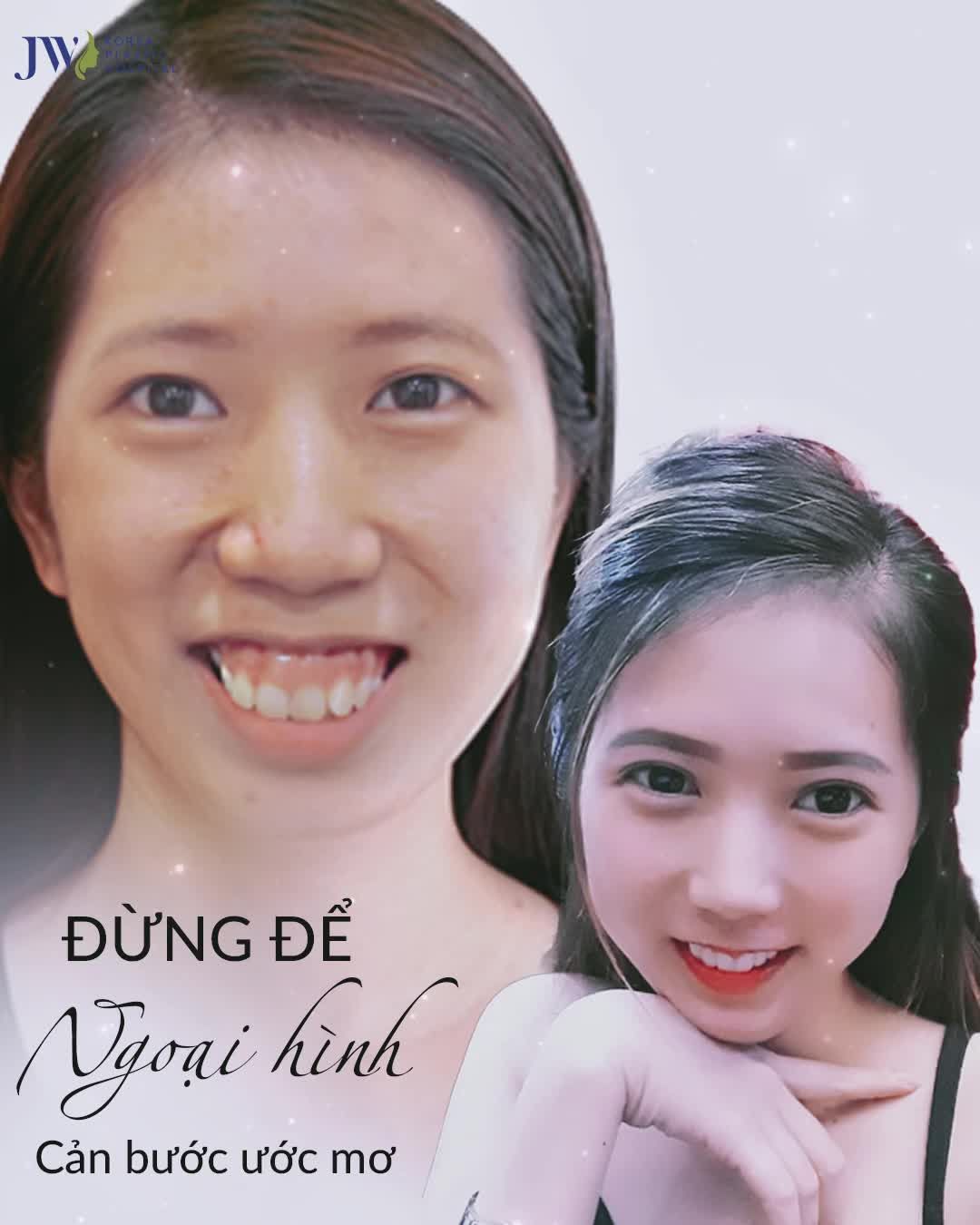 Cô gái THỊ NỞ suốt 20 năm hóa NÀNG TIÊN sau 1 ĐÊM nhờ phẫu thuật HÀM HÔ