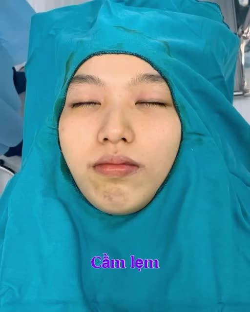 ĐỘN CẰM CỐ ĐỊNH NỘI SINH