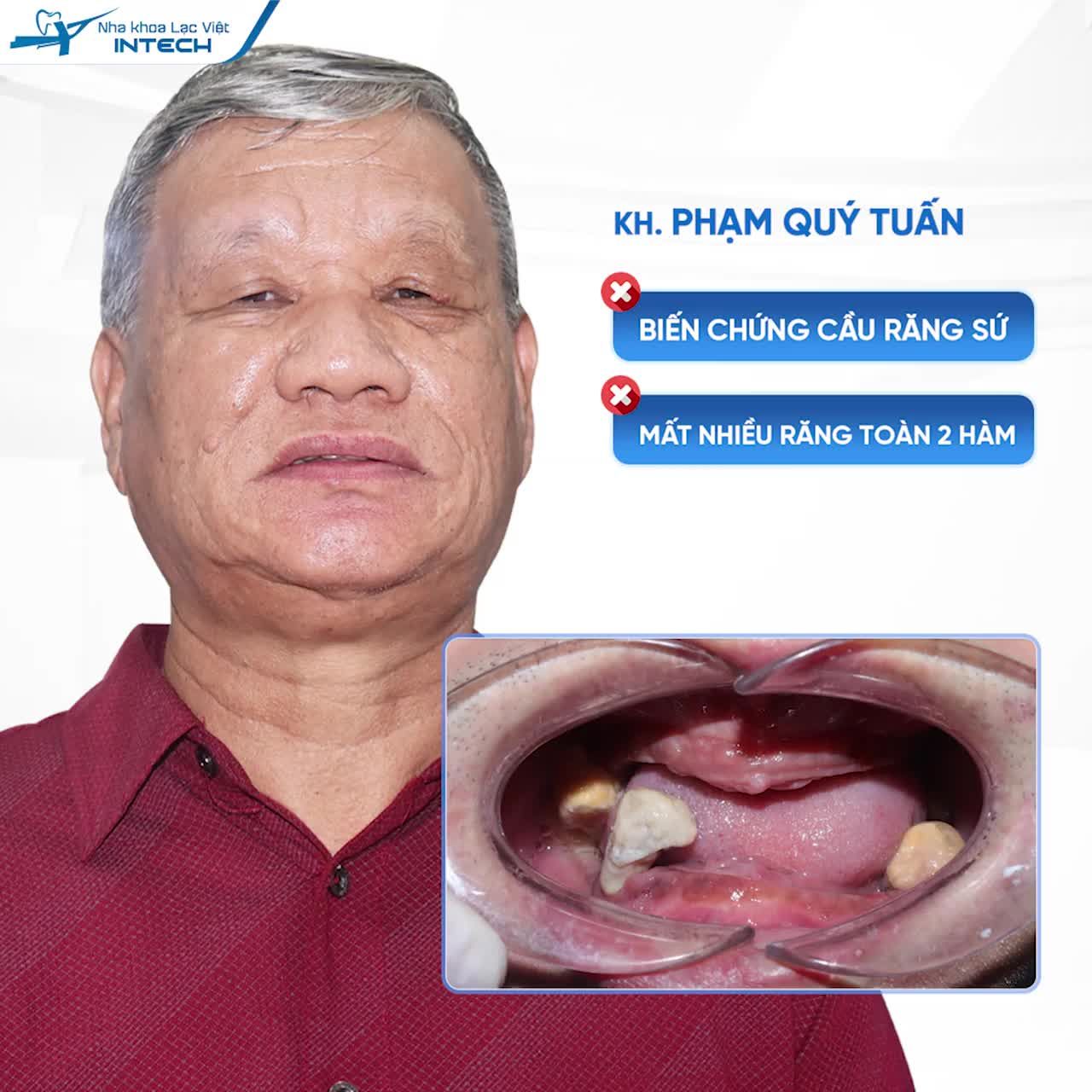 TÔI TỪ TỈNH XA, PHẢI TỚI TẬN NHA KHOA LẠC VIỆT INTECH TRỒNG RĂNG THÌ MỚI YÊN TÂM