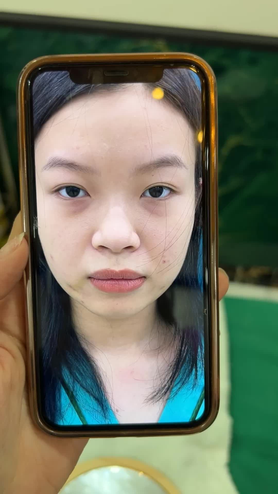 Kết quả sau 10 ngày nâng mũi cấu trúc Surgiform!