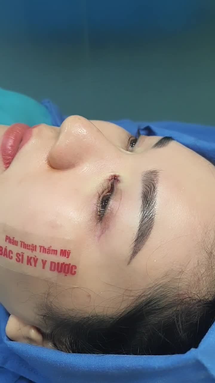 Mở góc mắt là phương pháp nhẹ nhàng, êm ái giúp đôi mắt bạn dài hơn và to ngang hơn.