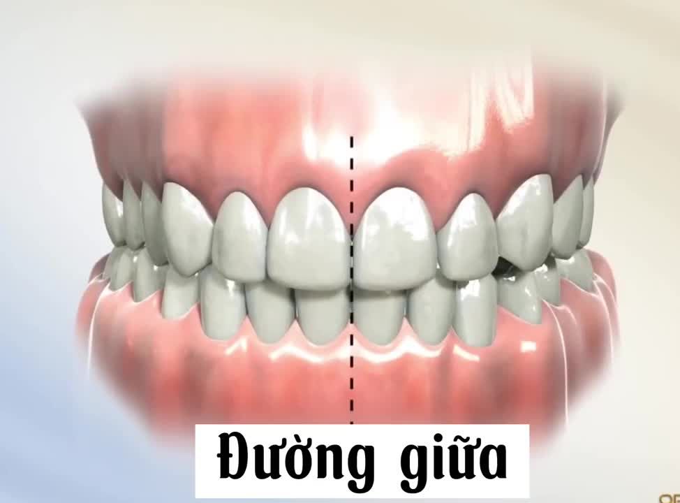 Nong hàm trong niềng răng như thế nào?