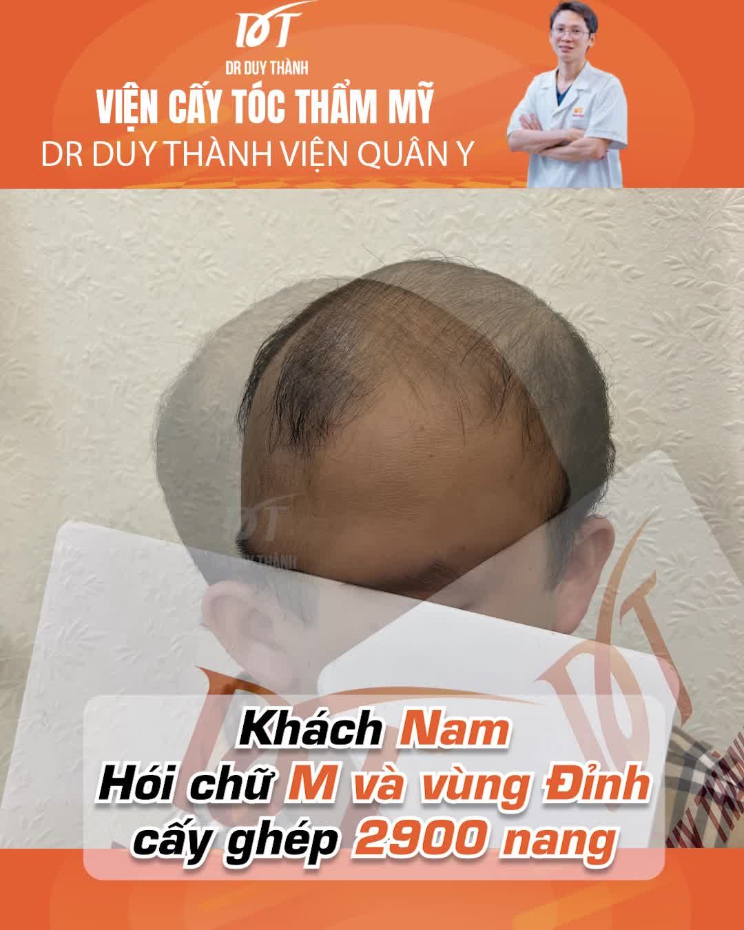 10 ngày bong vảy, kết quả sau cấy 2900 nang tóc - Dr Duy Thành