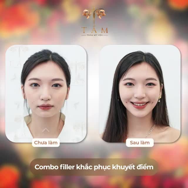 Bạn mong muốn có một khuôn mặt cân đối và hoàn hảo? Combo Filler tại Tấm sẽ giúp bạn đạt được điều đó.