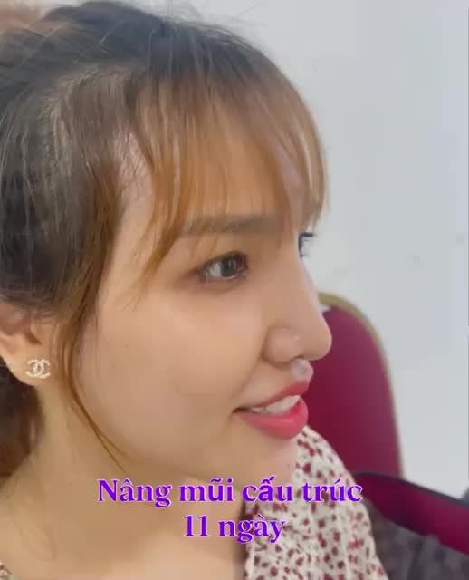 Nâng mũi cấu trúc sau 11 ngày đã hết sưng