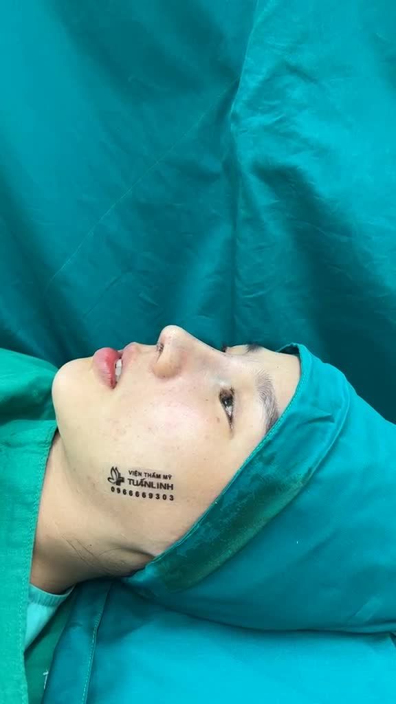Case mũi cấu trúc vừa hoàn thành