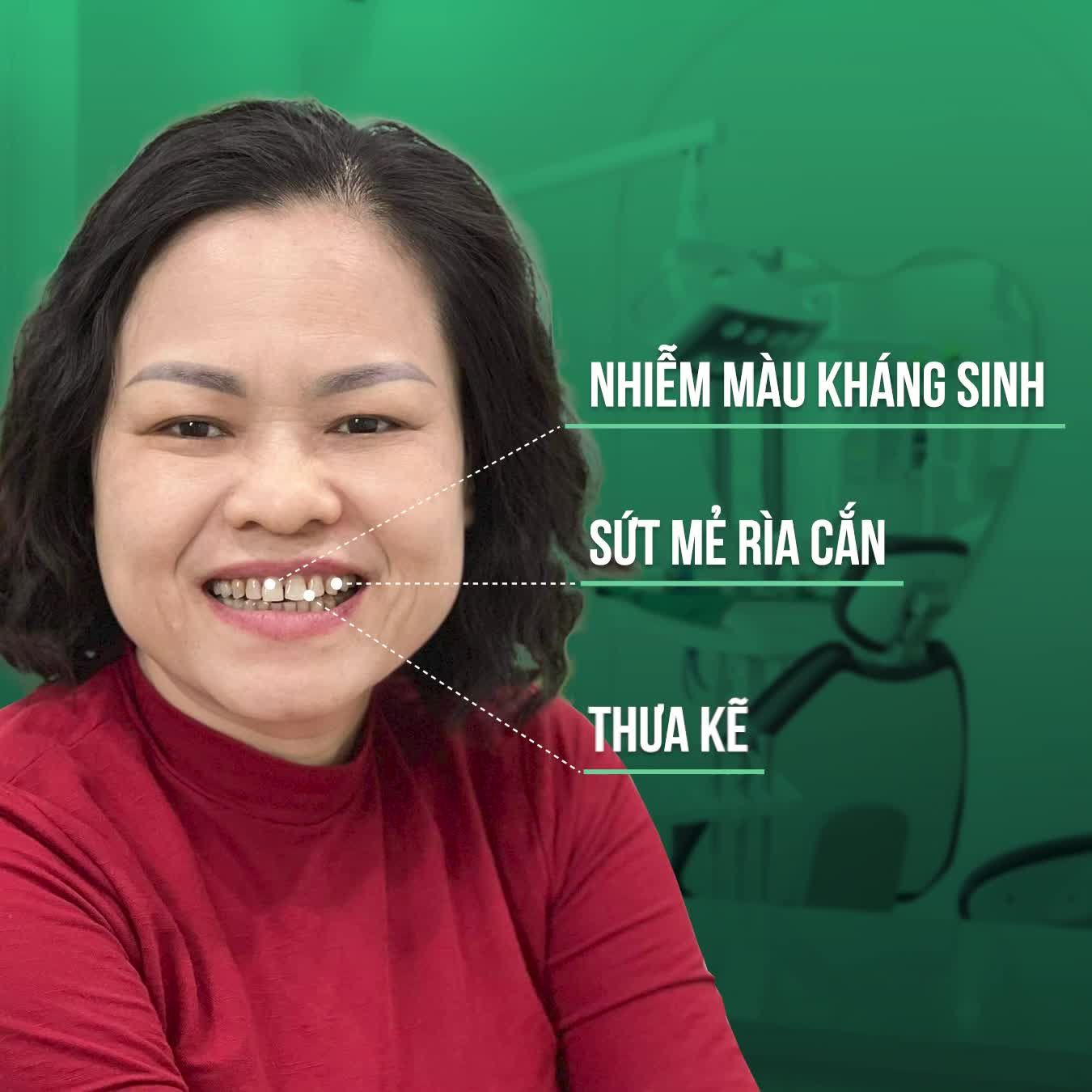 LOẠI BỎ NHIỄM MÀU KHÁNG SINH TETRACYCLINE - RĂNG ĐỀU ĐẸP NHƯ Ý