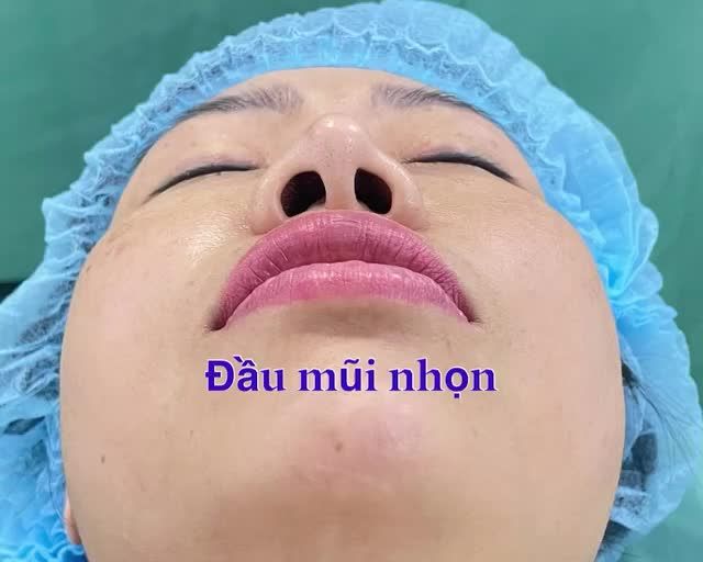 Khách hàng nâng mũi 10 năm. Hiện tại, cây sillicon bị tụt, đầu mũi nhọn lộ sống.