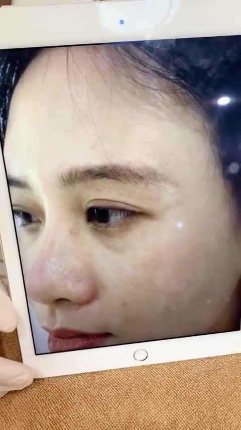 KH tìm đến Xuân Hương "cầu cứu" sau khi điều trị thất bại hút mực xăm mày tại cơ sở khác.