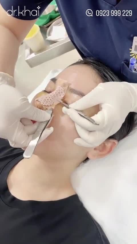 THÁO NẸP SAU 8 NGÀY NÂNG MŨI CẤU TRÚC