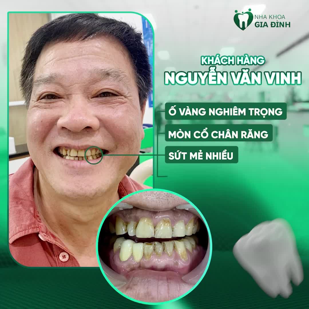 ĐỪNG ĐỂ HÀM RĂNG Ố VÀNG CẢN TRỞ SỰ TỰ TIN CỦA BẠN