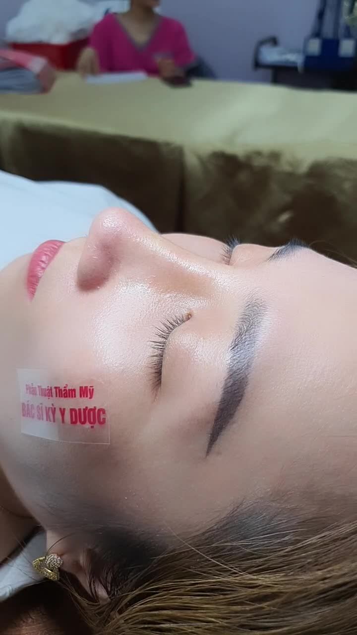 Nâng Mũi ALINE Cấu Trúc 2 Lớp Sau 10 Ngày