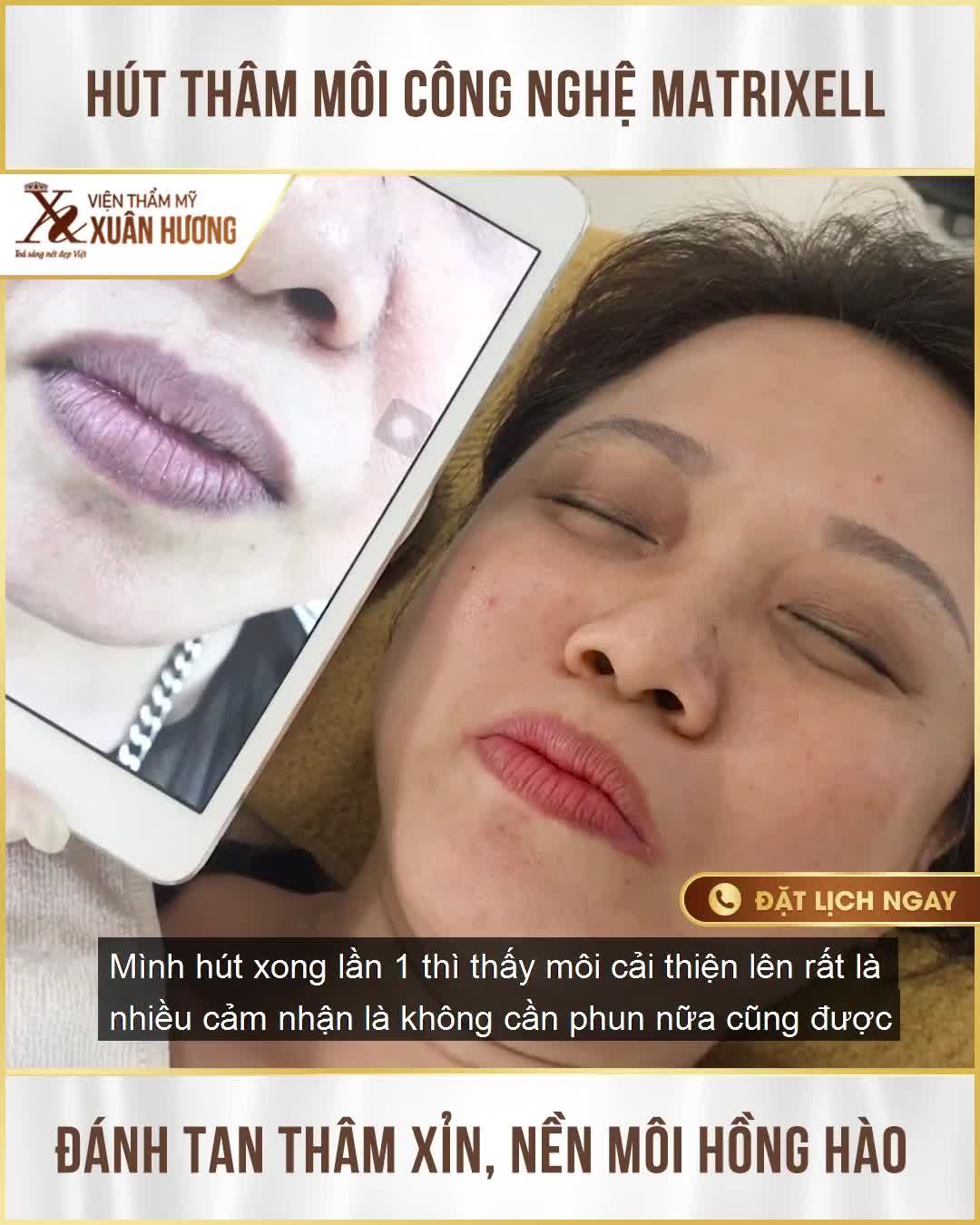 “Hút xong thâm môi lần 1, mình thấy môi cải thiện rất nhiều, không cần phun môi nữa cũng được, màu sắc rất tự nhiên”
