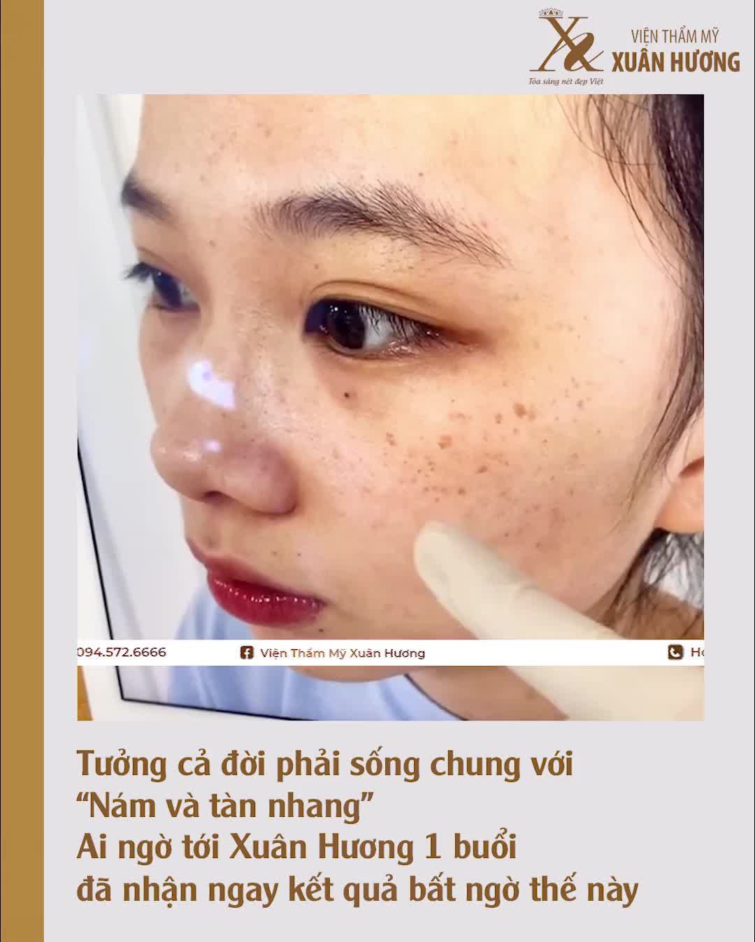 SAO PHẢI SỐNG CHUNG VỚI TÀN NHANG KHI CHỈ CẦN MỘT LẦN THỰC HIỆN LÀ HẾT NHỈ?