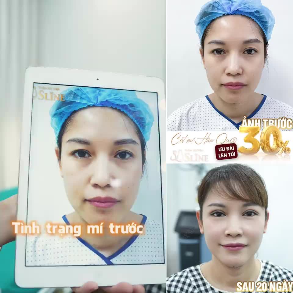 GIẢM ĐẾN 30% - CHO DỊCH VỤ CẮT MÍ (Áp dụng : từ 19/6/2023 - 25/6/2023)