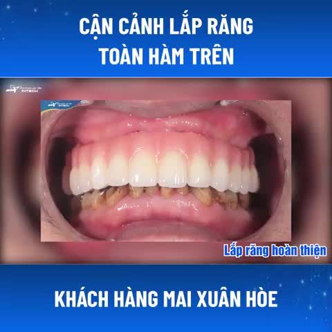 CẬN CẢNH LẮP RĂNG TOÀN HÀM TRÊN - KHÁCH HÀNG MAI XUÂN HÒE