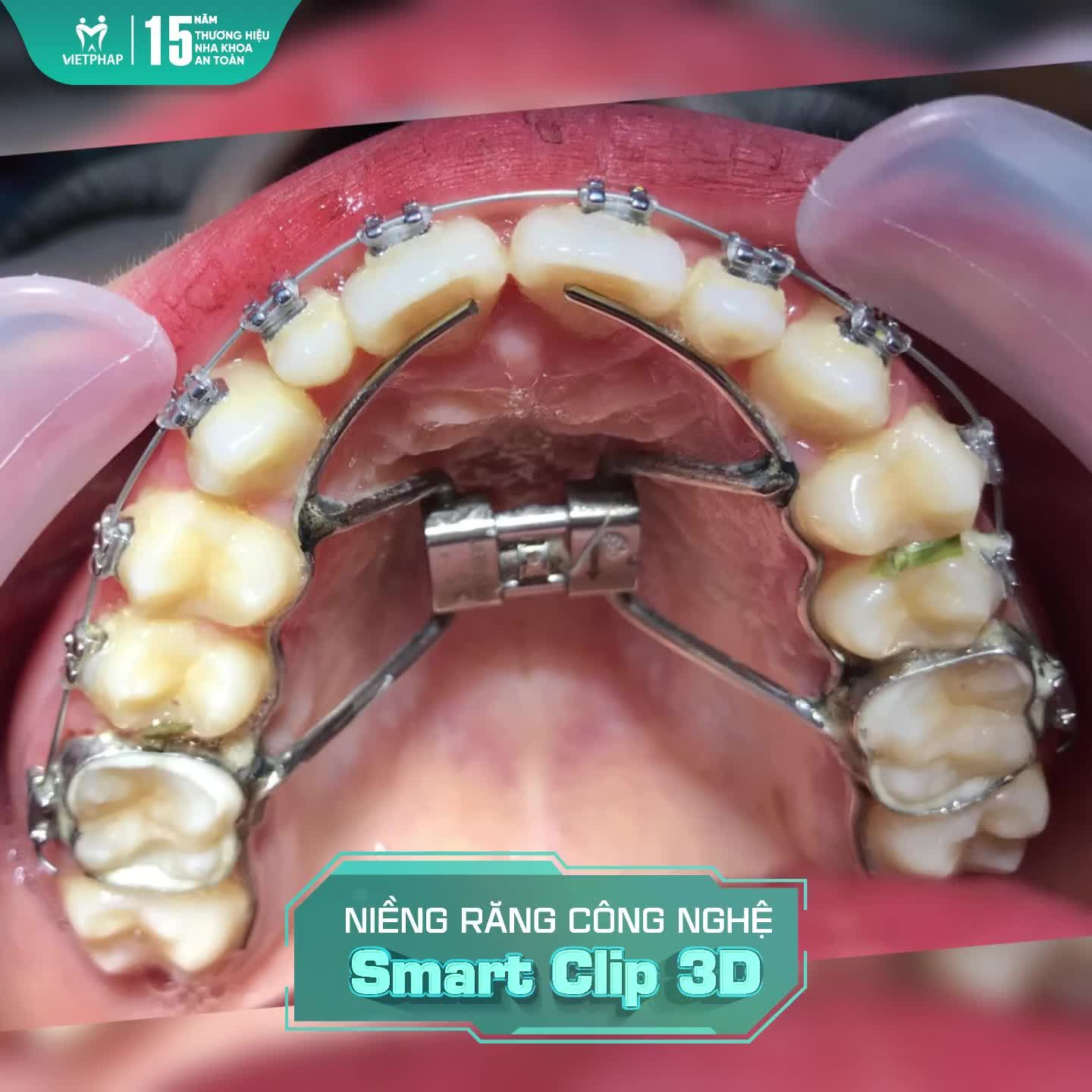 Cùng tìm hiểu qua câu chuyện trải nghiệm của Mai Linh khi niềng răng tại Việt Pháp!