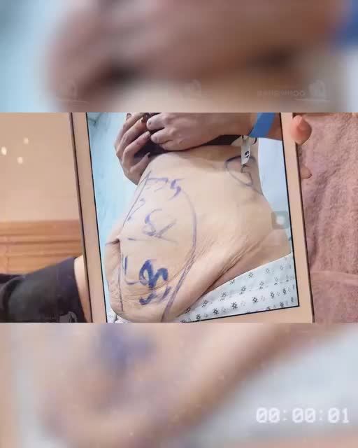 5 NĂM 4 BÉ VÀ CÂU CHUYỆN CHIẾC BỤNG MỠ ĐƯỢC LOẠI BỎ