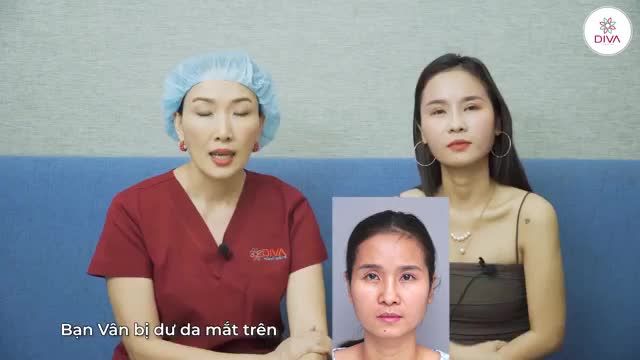 SỬA LỖI THẨM MỸ: MẮT NHIỀU MÍ, KHUYẾT SÂU MÍ DƯỚI VÀ KẾT QUẢ SAU THỰC HIỆN