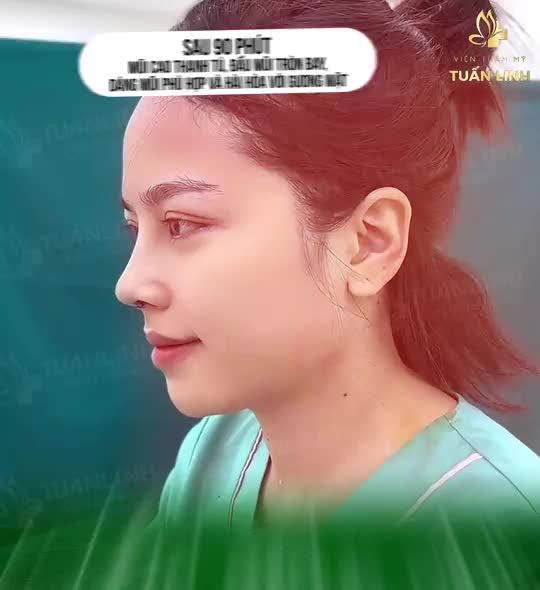 Sự thay đổi...Của một chiếc mũi sau 10 ngày phẫu thuật sẽ như thế nào??