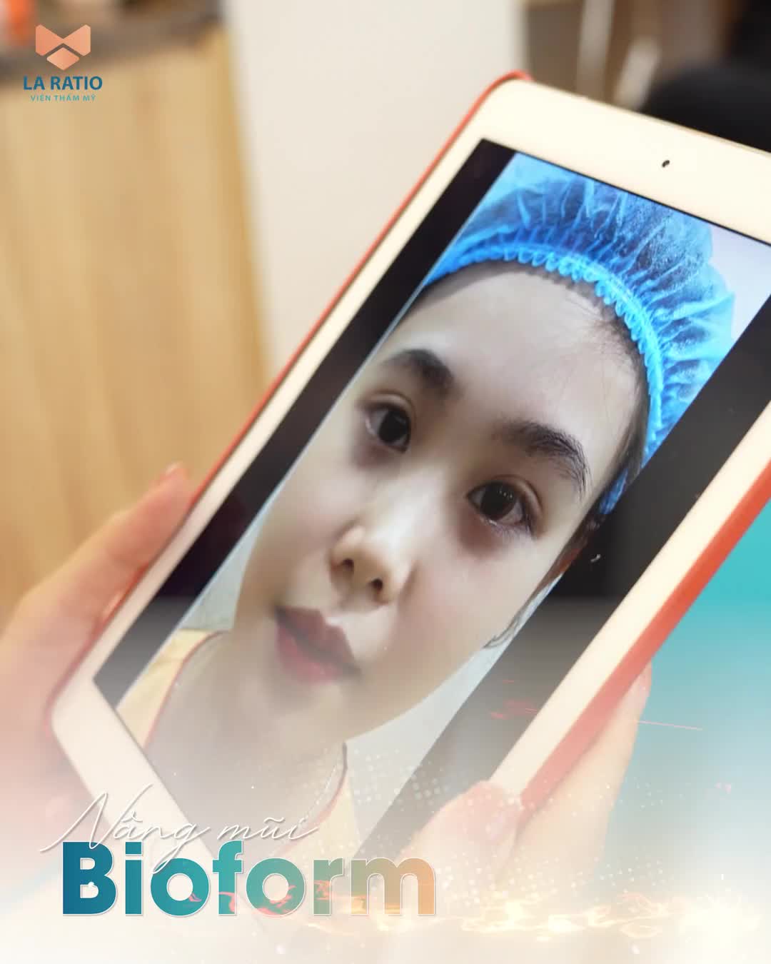 CÔ BÉ GEN Z - KHÁC BIỆT HẲN SAU KHI NÂNG MŨI BIOFORM