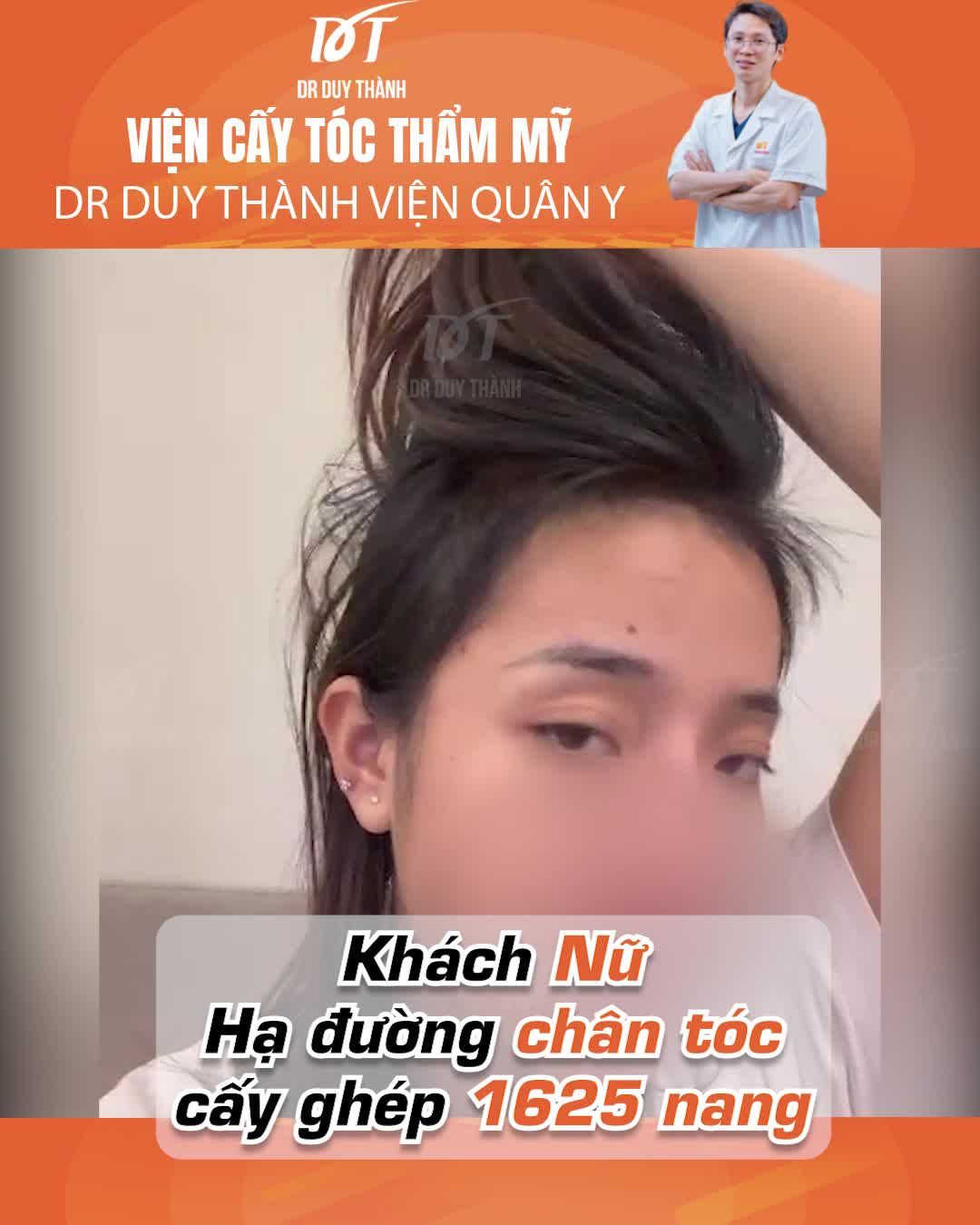 Xem thêm 107 video Cấy Tóc của bác sĩ Dr Duy Thành