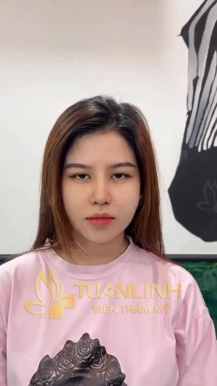 'Lộ diện'' Dáng mũi sau 1 tháng nâng tại Tuấn Linh và ''Mẹo nhỏ'' giúp bạn nhận diện được loại sụn bác sĩ đặt vào trong mũi mình!!