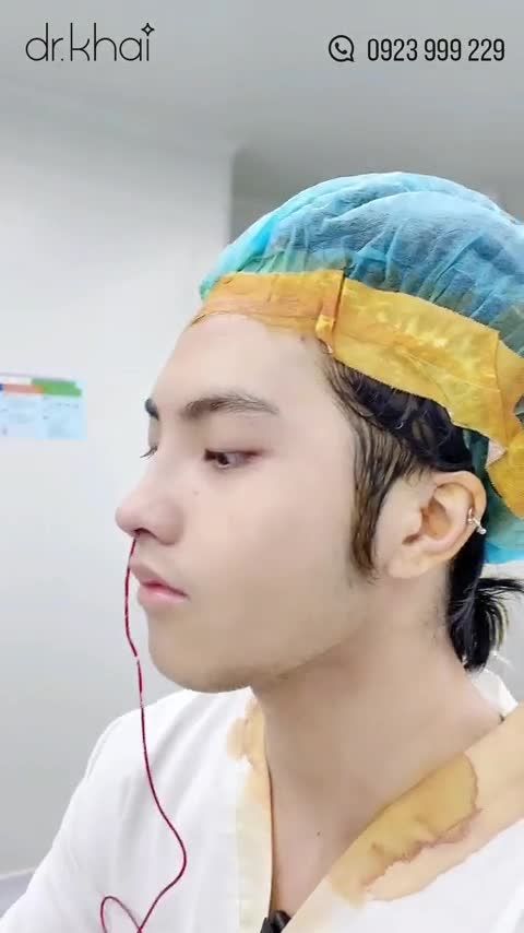 CHÀNG TRAI VIỆT KIỀU MỸ HÓA NAM THẦN SAU KHI NÂNG MŨI CẤU TRÚC