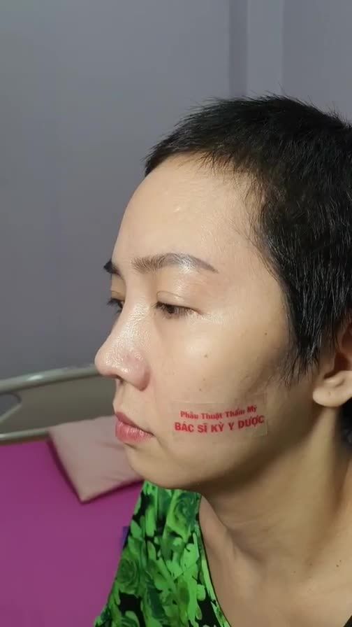 Chị khách đến tái khám sau 10 tháng Nâng Mũi ALINE Bán Cấu Trúc 2 Lớp.