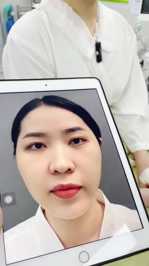 MŨI ĐẸP SAU HƠN 60 PHÚT PHẪU THUẬT CHÚC MỪNG KHÁCH YÊU VỚI DIỆN MẠO XINH ĐẸP TUYỆT VỜI