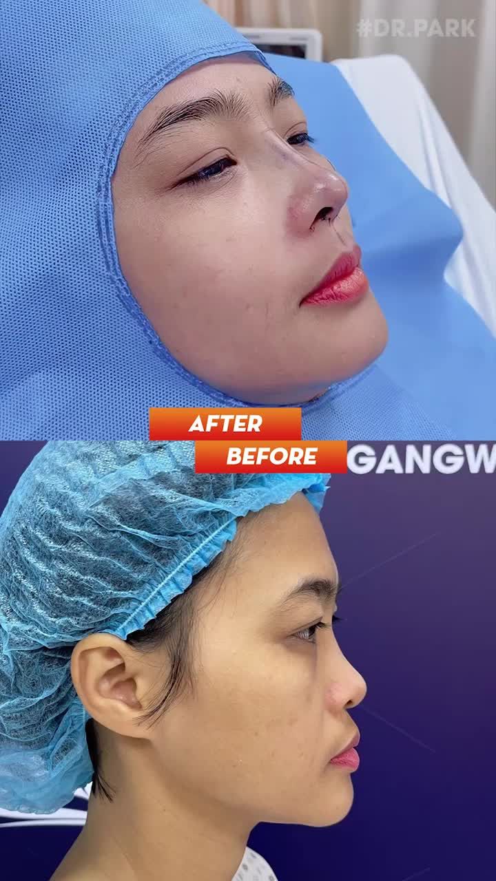 NÂNG MŨI - NHỮNG THÔNG TIN QUAN TRỌNG BẠN CẦN BIẾT