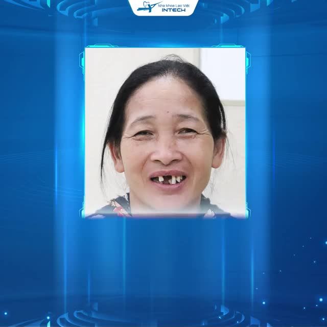 Trồng răng Implant KHÔNG ĐAU - Chọn Lạc Việt Intech Hải Phòng ️