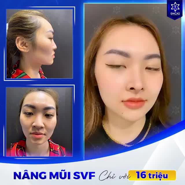 NÂNG MŨI SVF chỉ với 16 triệu
