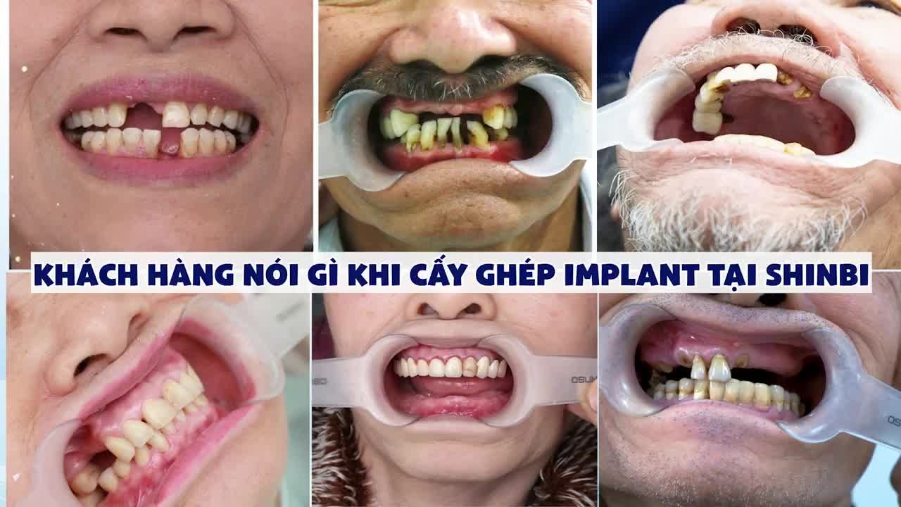TRẢI NGHIỆM CẮM IMPLANT KHÔNG HỀ ĐAU ĐỚN Ở SHINBI